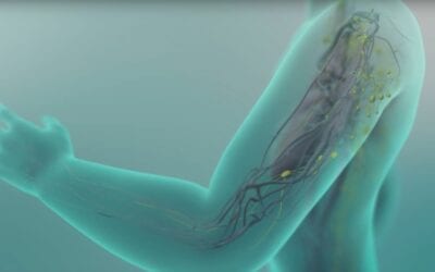 A Lymph Node Transplant Can Prevent or Treat Lymphedema in Mastectomy Patients
